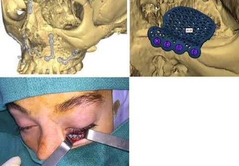 Patient-Specific Orbital Implants & Surgical Guides