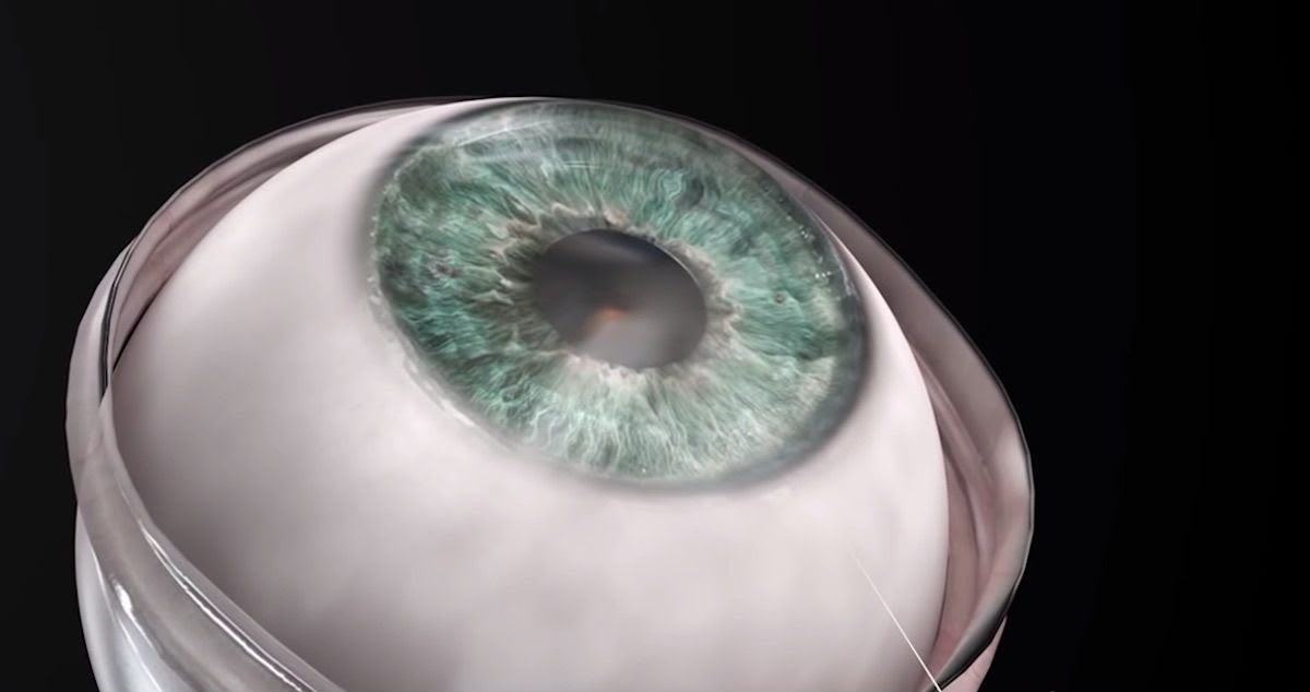 3D-Printed Cornea