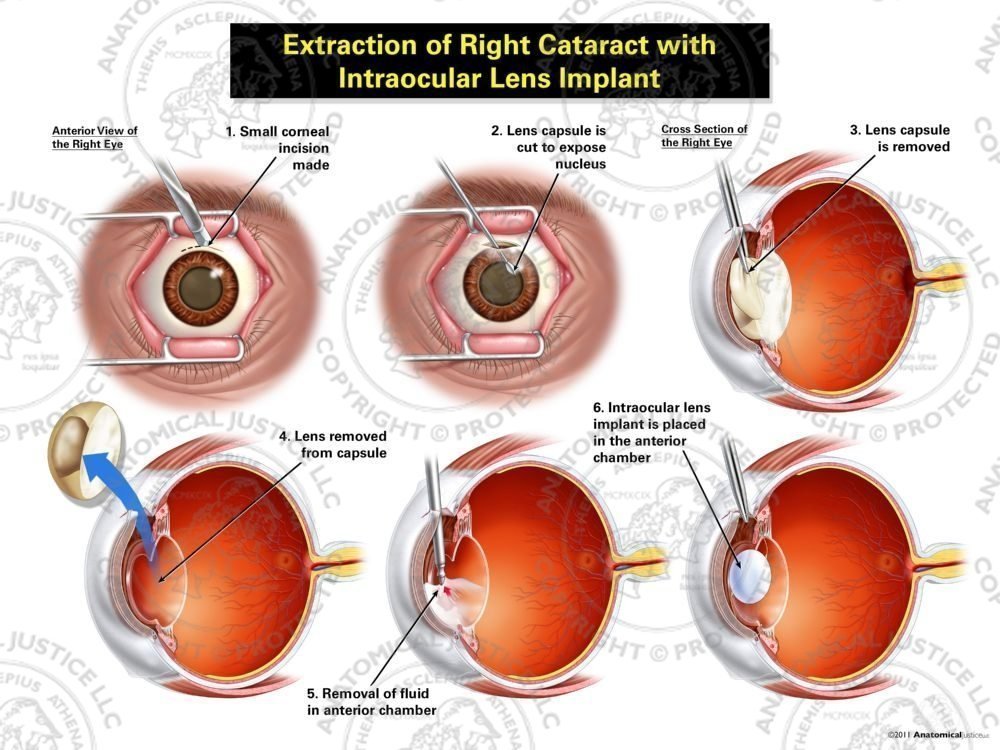 Next-Generation Intraocular Lens Innovations